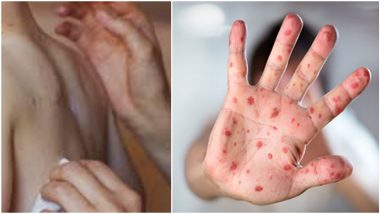 Measles Report: एका गोवरच्या रुग्णाकडून तब्बल 18 रुग्णांना होवू शकते लागण, WHO कडून विशेष सुचना जारी